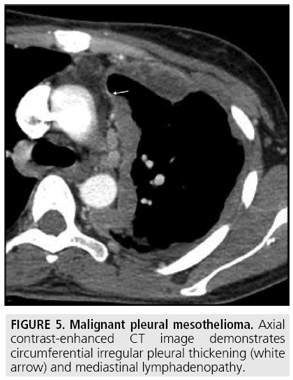 what is solid papillary carcinoma