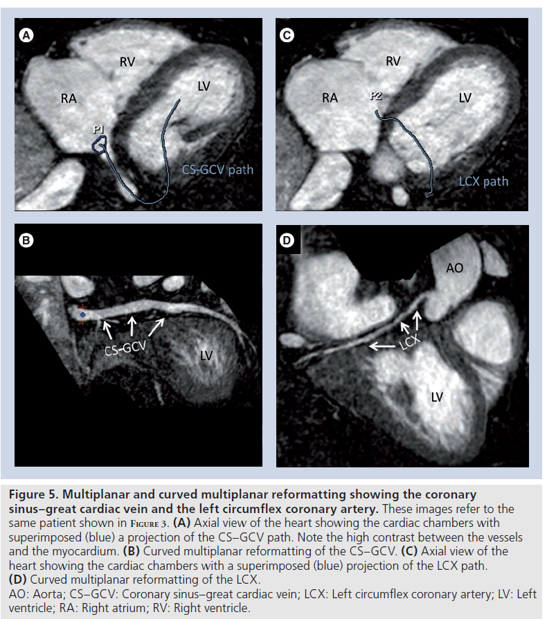 imaging-in-medicine-circumflex-coronary