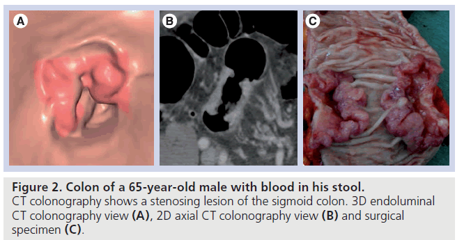 imaging-in-medicine-colonography-view