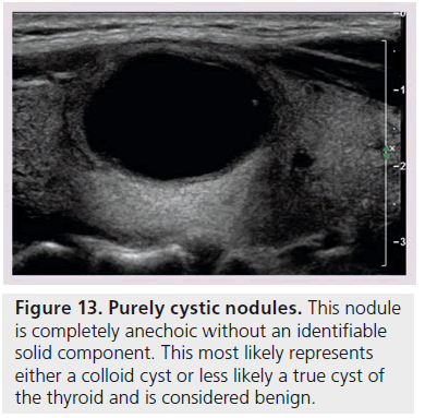 imaging-in-medicine-completely–anechoic