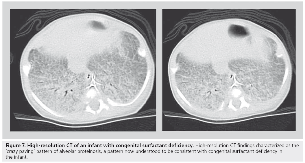 imaging-in-medicine-congenital-surfactant