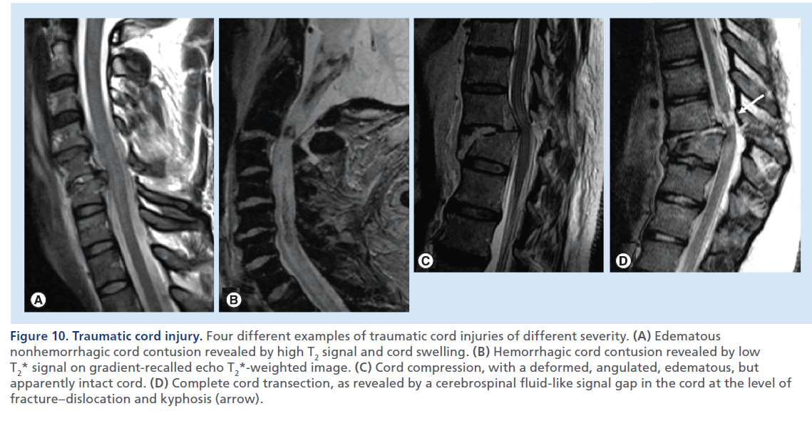 imaging-in-medicine-cord–swelling
