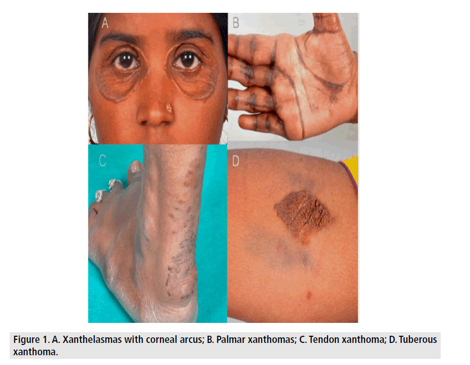 imaging-in-medicine-corneal-arcus