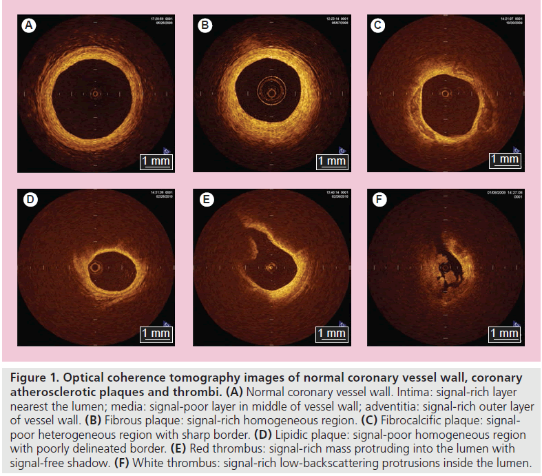 imaging-in-medicine-coronary-vessel