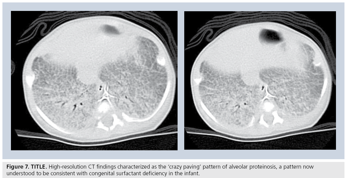 imaging-in-medicine-crazy-paving