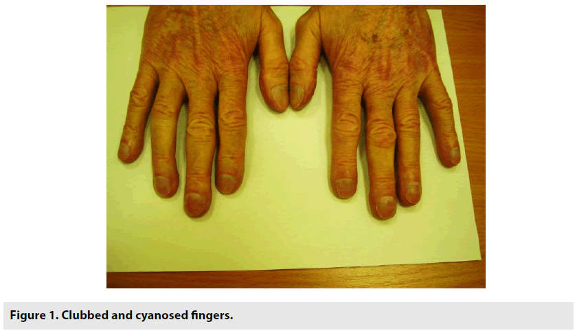 imaging-in-medicine-cyanosed-fingers