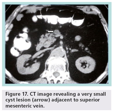 imaging-in-medicine-cyst-lesion