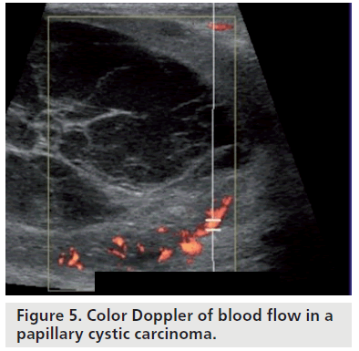 imaging-in-medicine-cystic-carcinoma