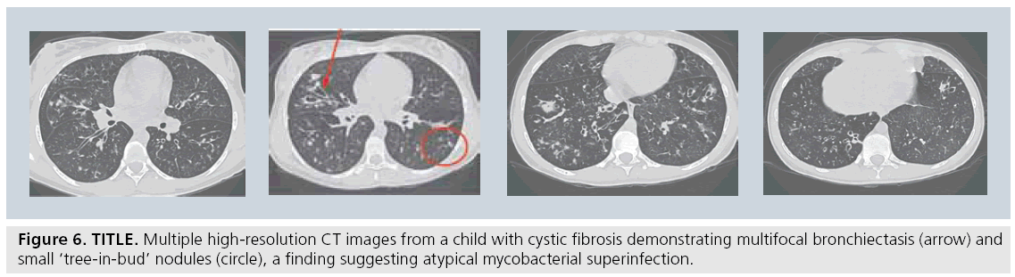 imaging-in-medicine-cystic-fibrosis
