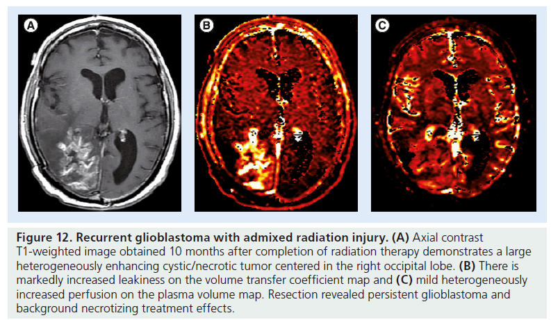 T1 weighted mri blood