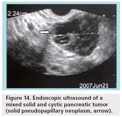 imaging-in-medicine-cystic-pancreatic
