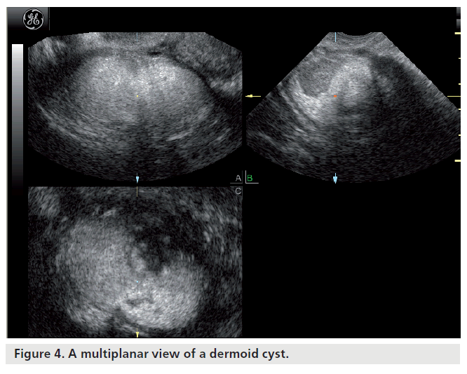 imaging-in-medicine-dermoid-cyst