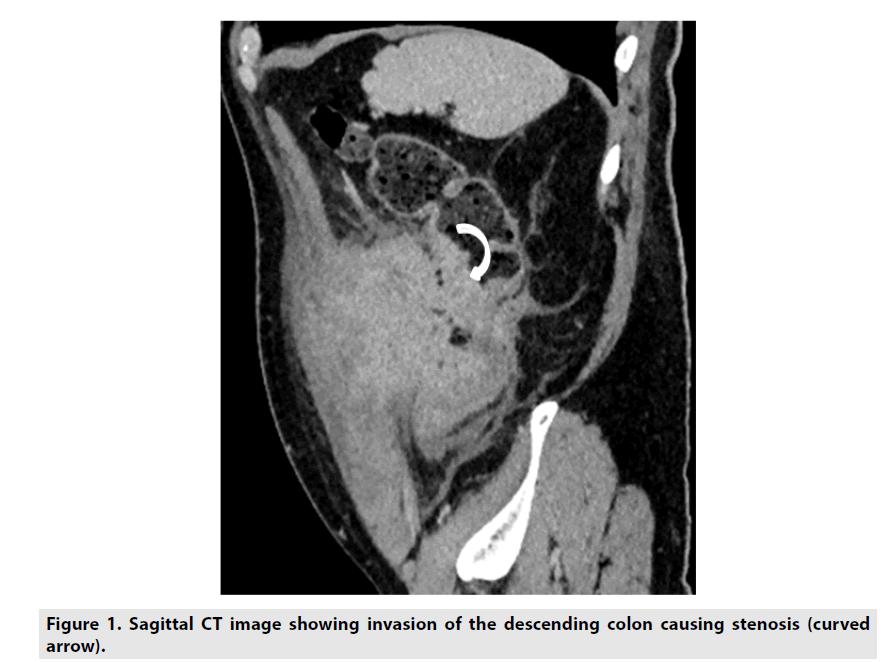 imaging-in-medicine-descending-colon