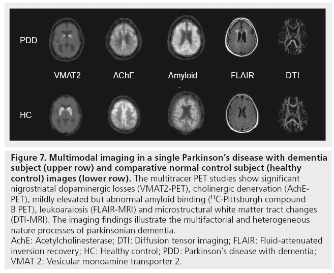 imaging-in-medicine-dopaminergic-losses