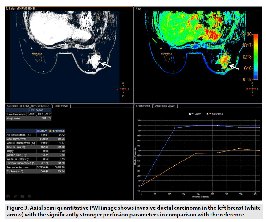 imaging-in-medicine-ductal-carcinoma