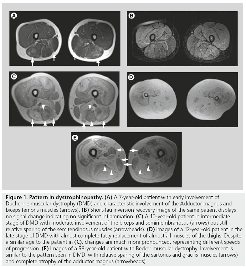 imaging-in-medicine-dystrophinopathy