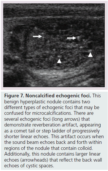 imaging-in-medicine-echogenic-foci
