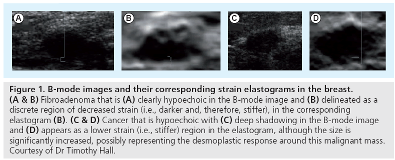 imaging-in-medicine-elastograms