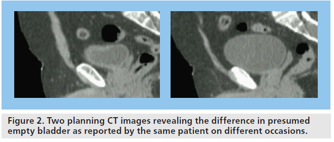 imaging-in-medicine-empty-bladder