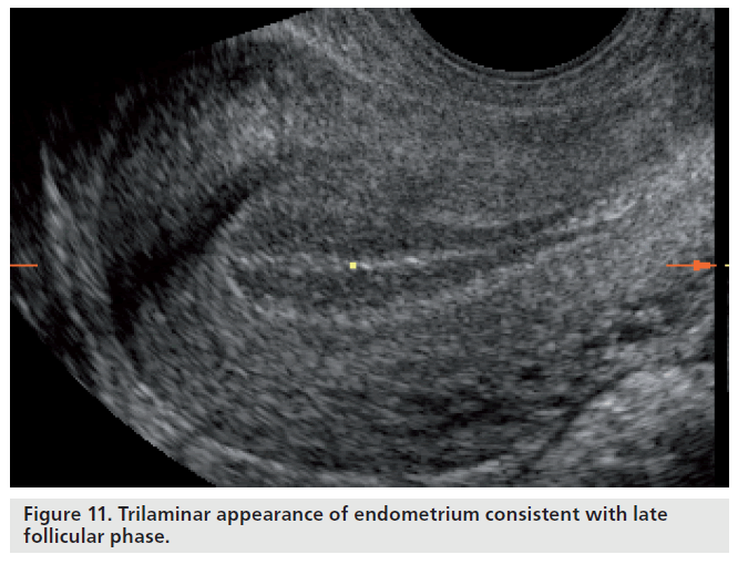 imaging-in-medicine-endometrium-consistent