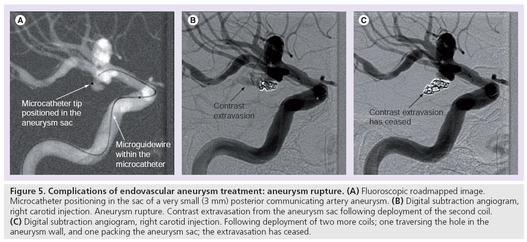 imaging-in-medicine-endovascular-aneurysm
