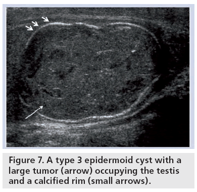 imaging-in-medicine-epidermoid-cyst