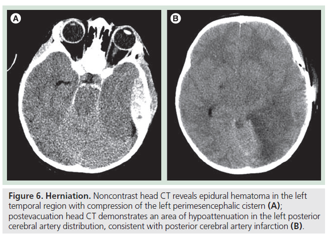 imaging-in-medicine-epidural-hematoma