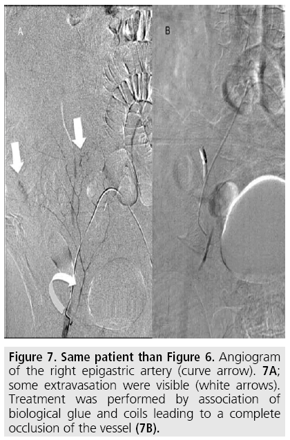 imaging-in-medicine-epigastric-artery