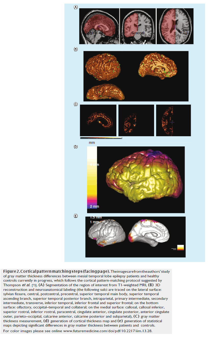 imaging-in-medicine-epilepsy-patients