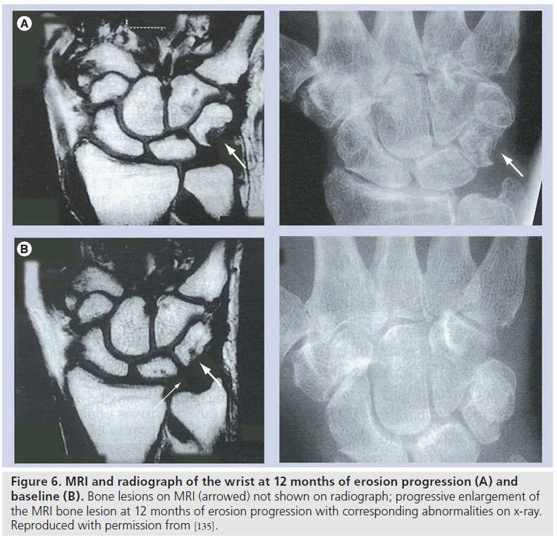 imaging-in-medicine-erosion-progression