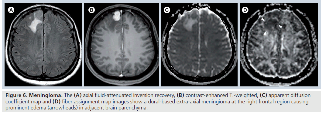 imaging-in-medicine-extra-axial