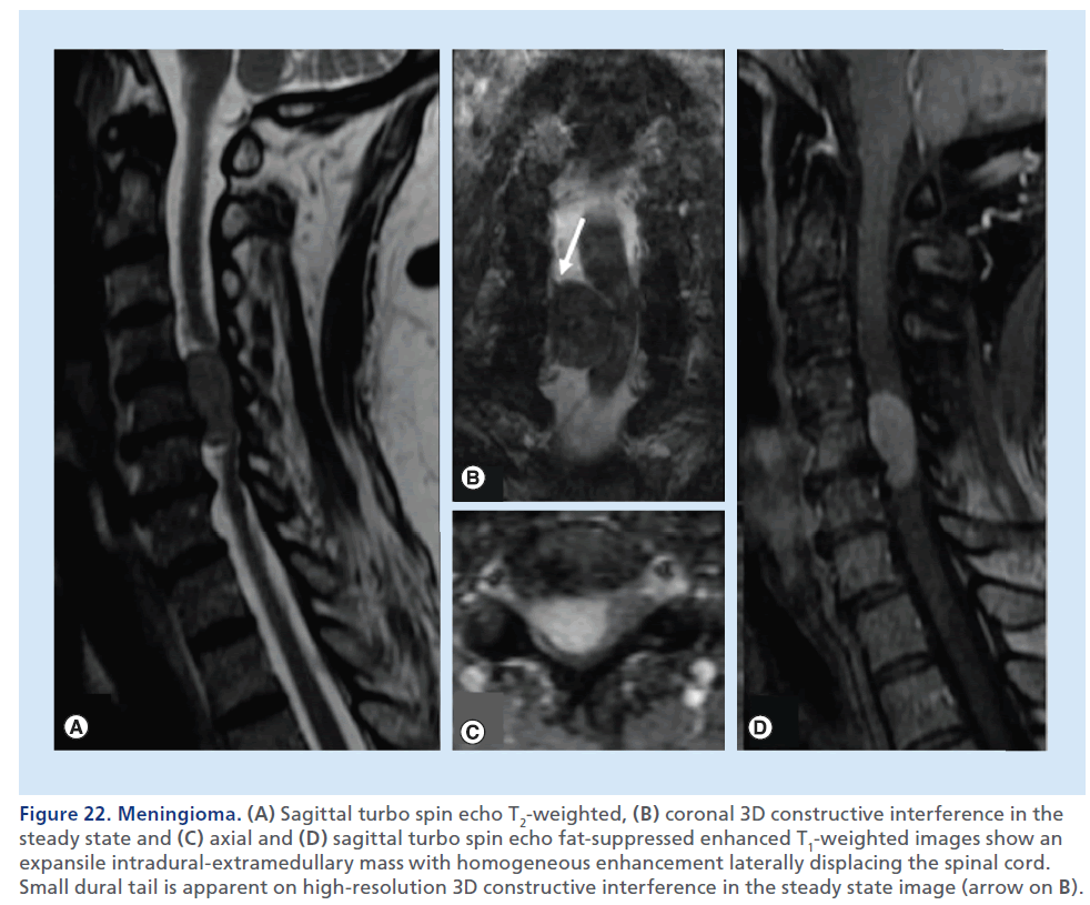imaging-in-medicine-extramedullary–mass