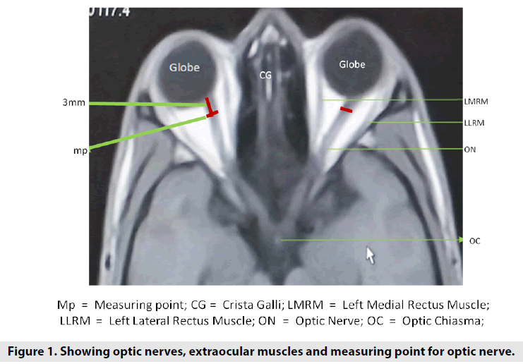 imaging-in-medicine-extraocular-muscles