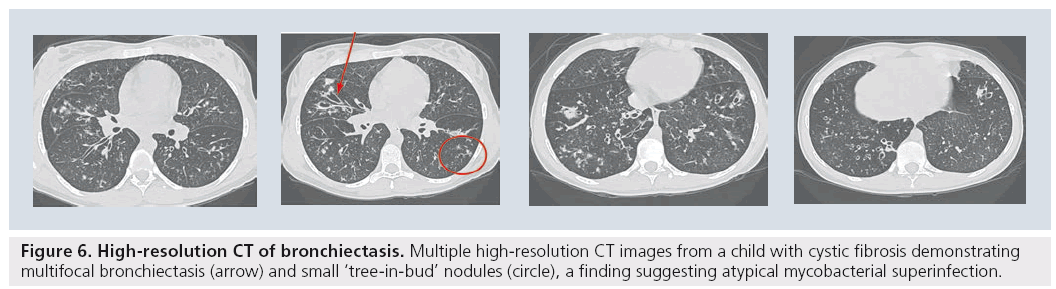 imaging-in-medicine-fibrosis-demonstrating