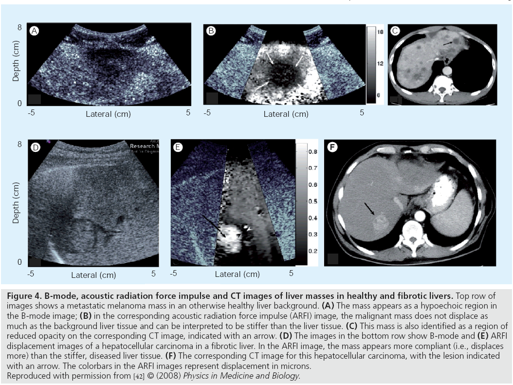 imaging-in-medicine-fibrotic-livers