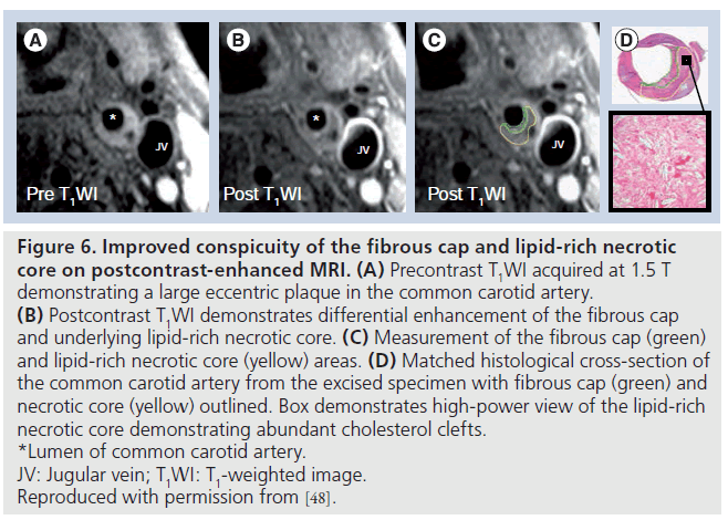 imaging-in-medicine-fibrous-cap