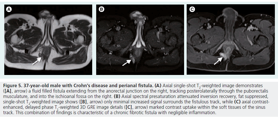 imaging-in-medicine-filled-fistula