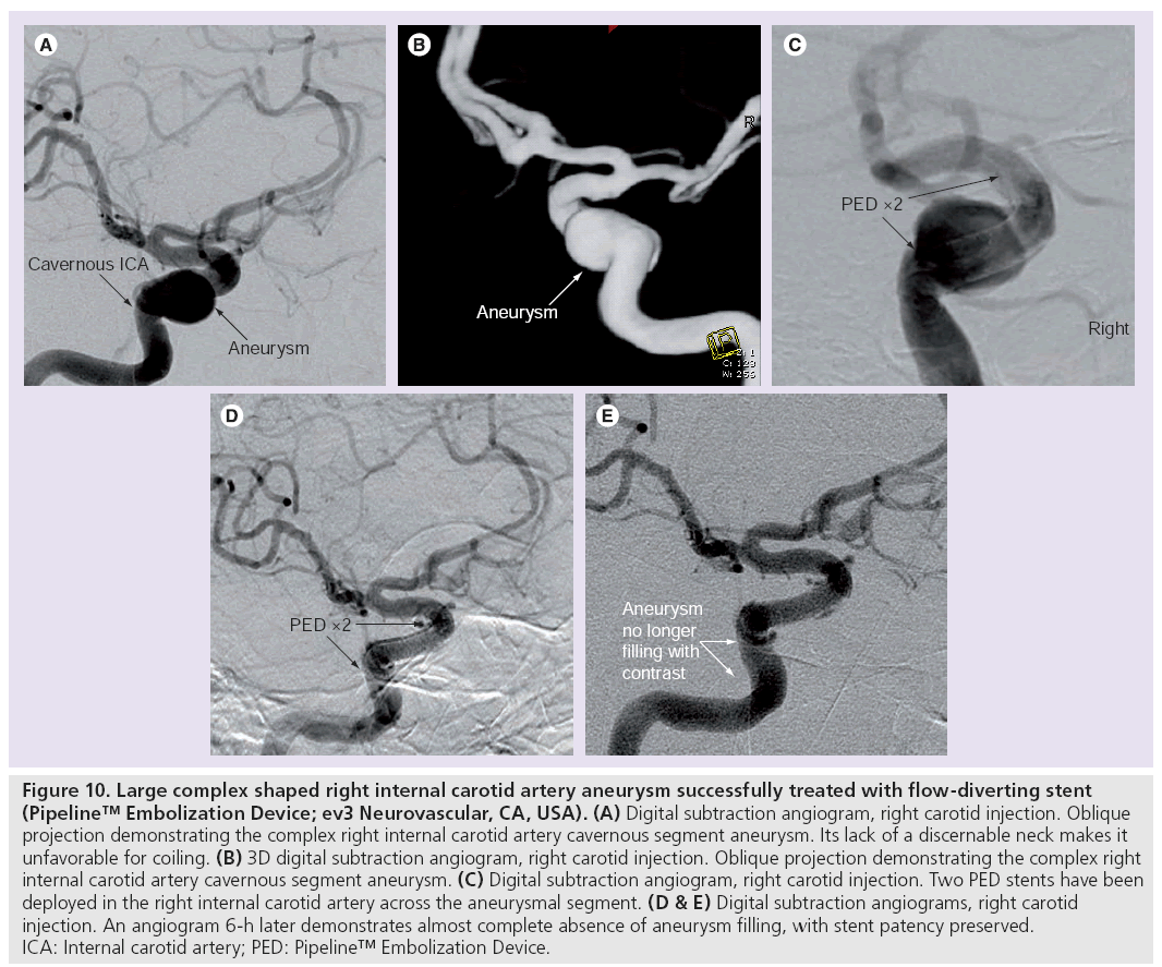 imaging-in-medicine-flow-diverting