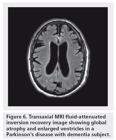 imaging-in-medicine-fluid-attenuated