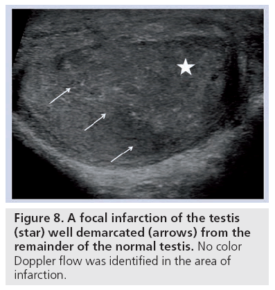 imaging-in-medicine-focal-infarction