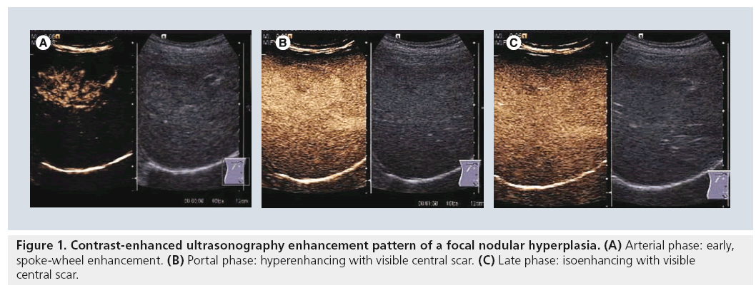 imaging-in-medicine-focal-nodular