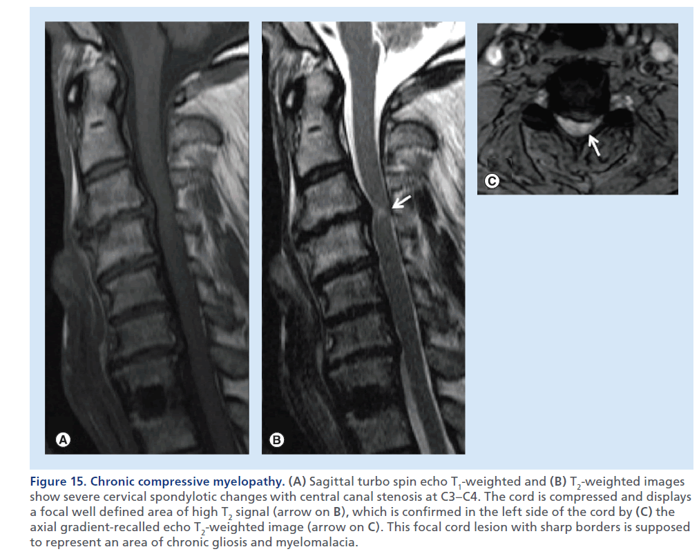 imaging-in-medicine-focal–cord