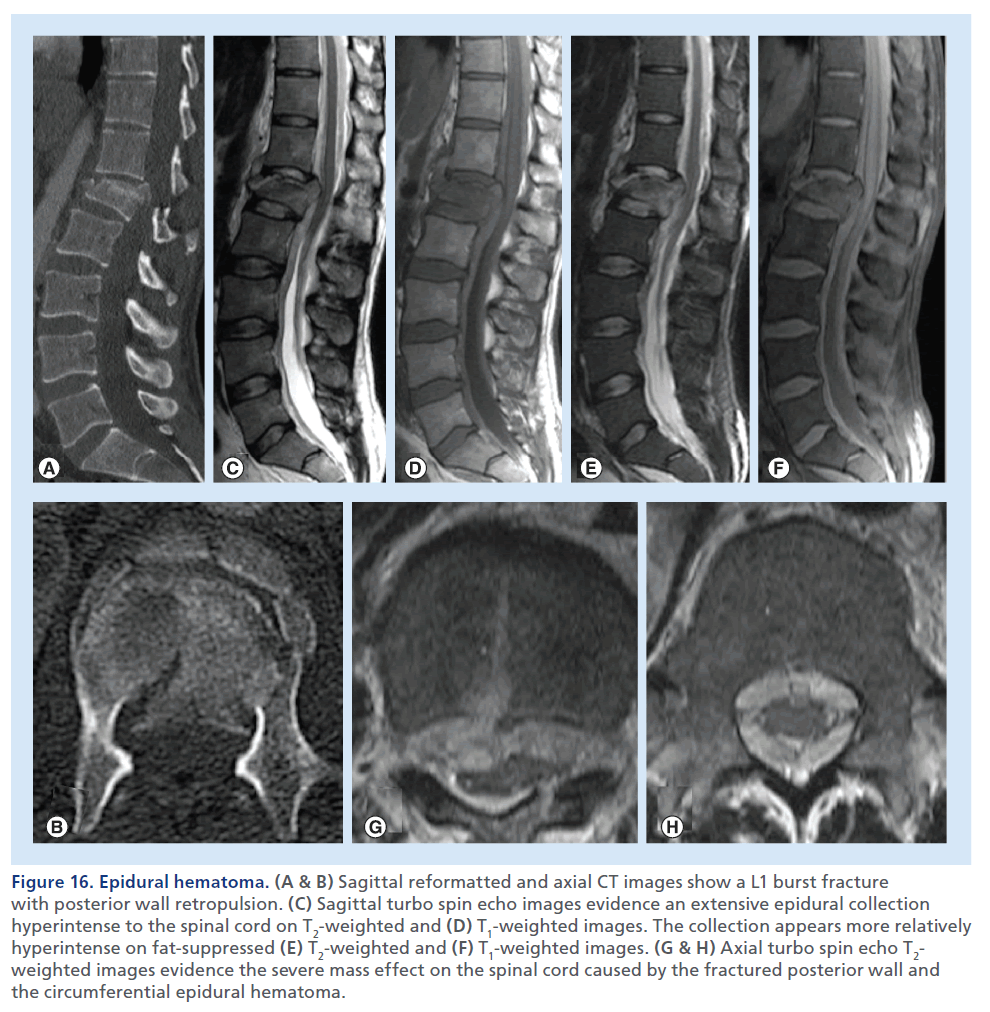 imaging-in-medicine-fractured–posterior