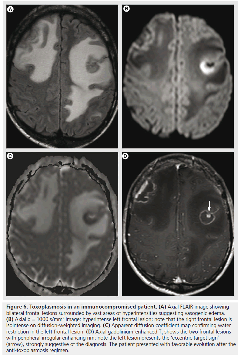 Frontiers | Case Report: Atypical Solitary Brain Metastasis: The Role of MR  Spectroscopy In Differential Diagnosis