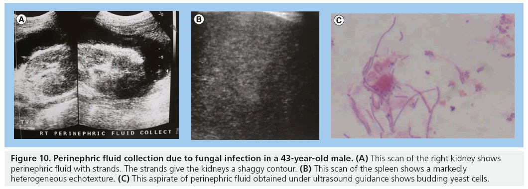 imaging-in-medicine-fungal-infection