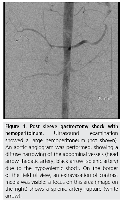 imaging-in-medicine-gastrectomy