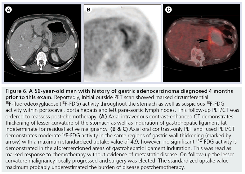 imaging-in-medicine-gastric-adenocarcinoma