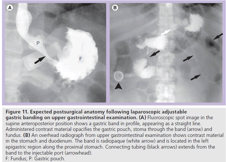 imaging-in-medicine-gastric-band