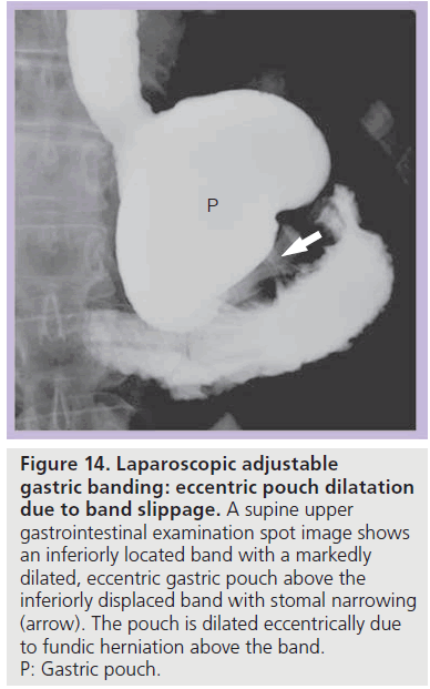 imaging-in-medicine-gastric-pouch