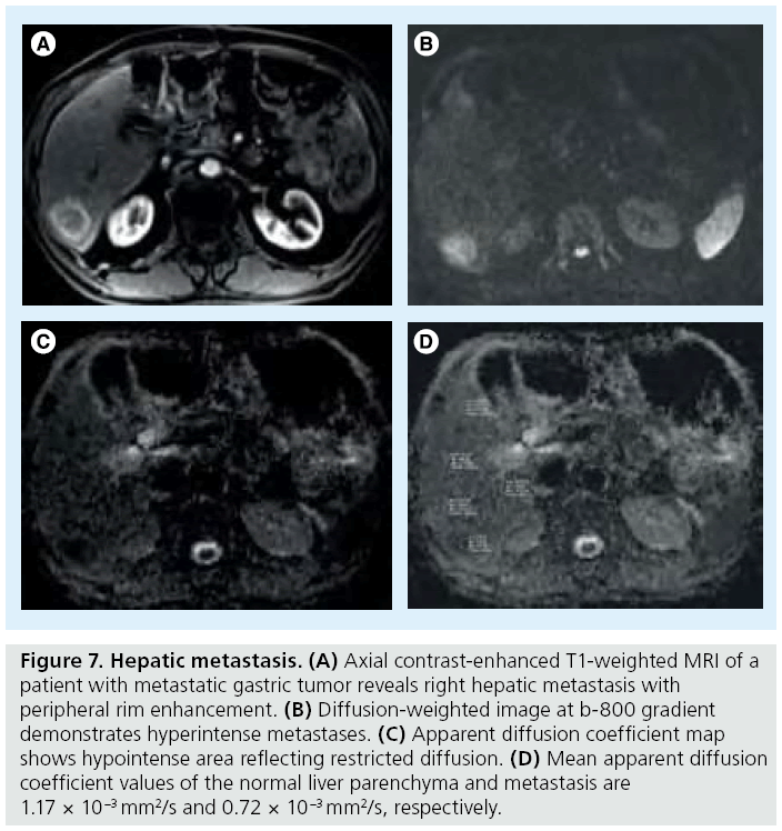 imaging-in-medicine-gastric-tumor